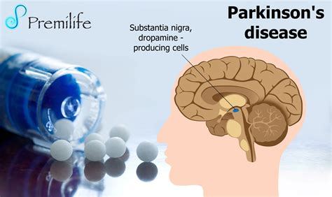 Parkinson's Disease - Premilife - Homeopathic Remedies