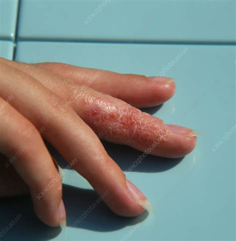 Eczema Affecting A Womanss Finger Stock Image M1500044 Science