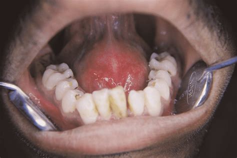 Pre Operative Photo Showing Dome Shaped Sublingual Swelling Download