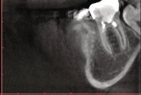 The Mandibular Right First Molar Had Immature Roots With Periapical
