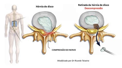 Cirurgia De Hérnia De Disco Lombar Dr Ricardo Teixeira