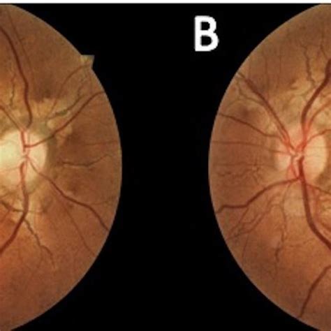 Fundus Photography Of The Macula And Optic Nerve Of Both Eyes A The
