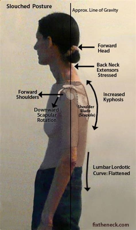 Incredible How To Fix Posture Neck Ideas Rawax