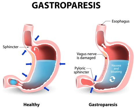Gastroparesis Causes Symptoms Diet Medications And Treatment