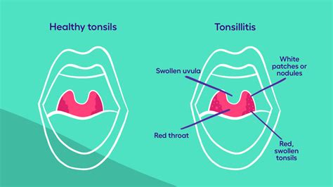 Swollen Tonsils With White Spots And Swollen Glands