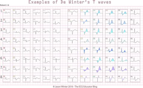 Represents an acute proximal occlusion (unlike wellen's sign which represents a subacute process). ECG Educator Blog : De Winters T waves