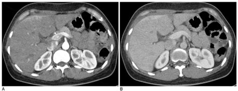 Axial Contrast Enhanced Ct Scan In A 40 Year Old Woman With Right Upper