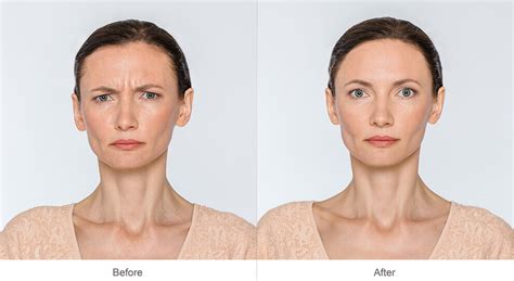 Botox Long Beach Botox Before And After Eplb