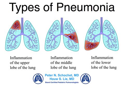 Dr Schochet Types Of Pneumonia Pediatric Pulmonologists