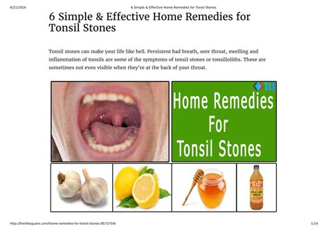 Ppt 6 Home Remedies For Tonsil Stones Powerpoint Presentation Free