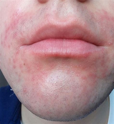 Perioral Dermatitis Rosacea And Facial Redness Forum