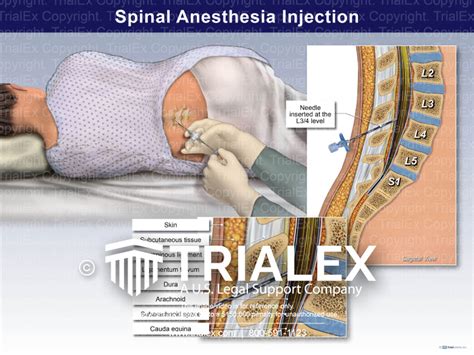 Spinal Anesthesia Injection Trialexhibits Inc