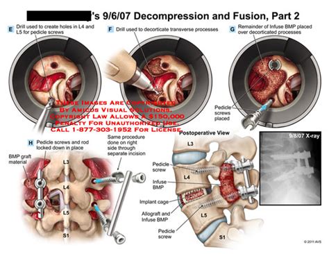 Amicus Illustration Of Amicussurgerylumbarspinedecompressionfusion