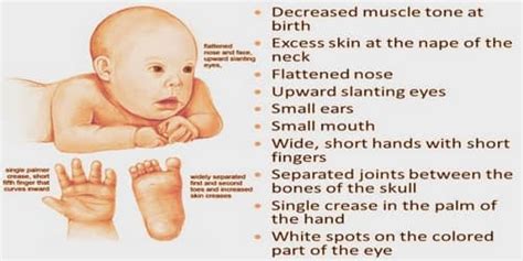 Down Syndrome Symptoms Diagnosis And Treatment Assignment Point