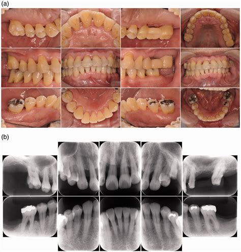 Treatment Of Severe Generalized Chronic Periodontitis In A Patient With