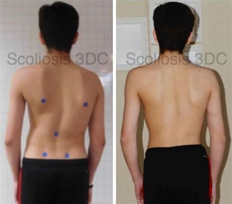 Postural Improvements Scoliosis Exercises Scoliosis Scoliosis Surgery
