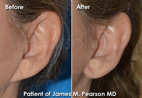 Pixie Ear Lobe Repair Photos Dr James Pearson Facial Plastic Surgery