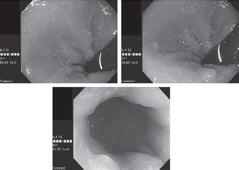 Figure 3 From A Case Of Rectopexy For Mucosal Prolapse Syndrome With