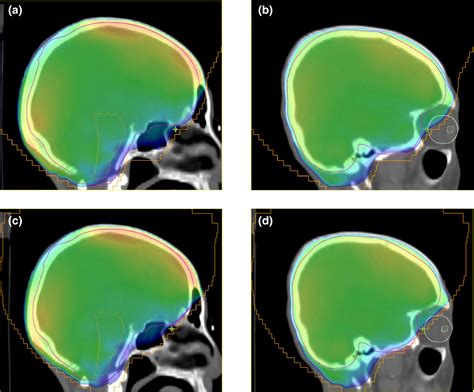 Feasibility Of Automated Planning For Whole‐brain Radiation Therapy