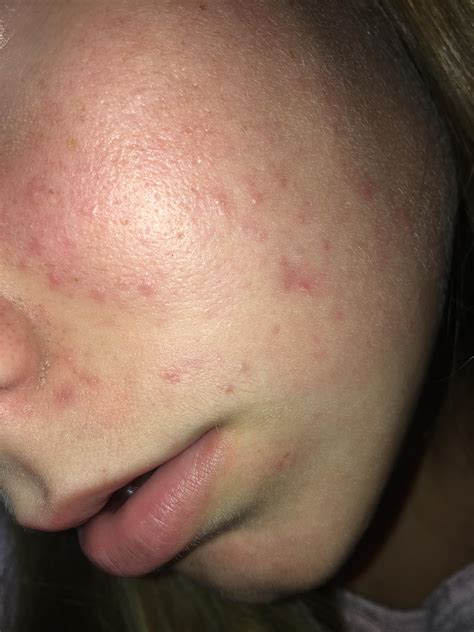 Small Bumps All Over Face And Cysts General Acne Discussion Acne Org