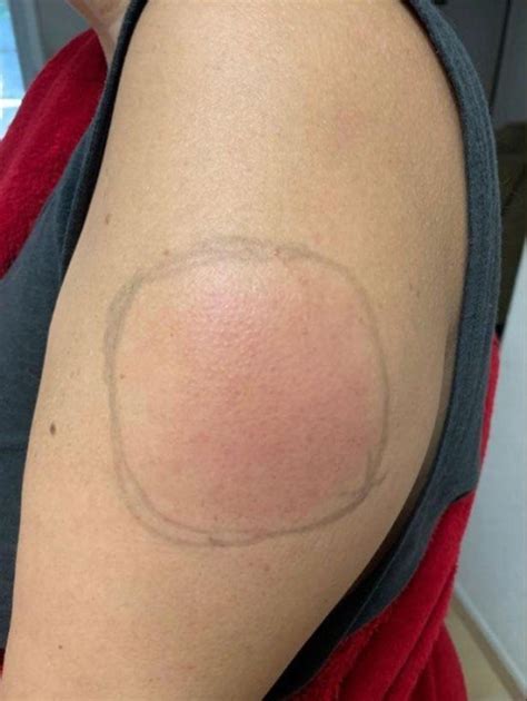 Rare Covid Vaccine Side Effect Leaves Some With Itchy Red Rash On Arm