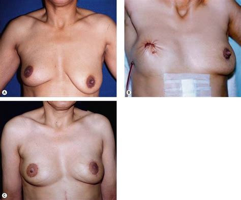 Omentum Reconstruction Of The Breast Plastic Surgery Key