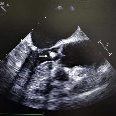 Transesophageal Echocardiogram Of Cardiac Amorphous Tumor Within The