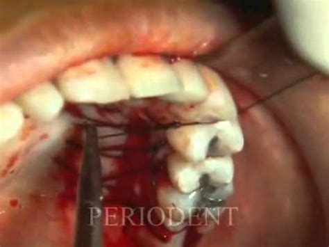 Are you in need of gum graft surgery? Gum Graft - YouTube