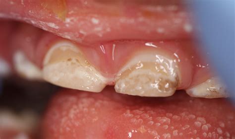 Staining Or Cavities On The Front Teeth Playtime Dentistry