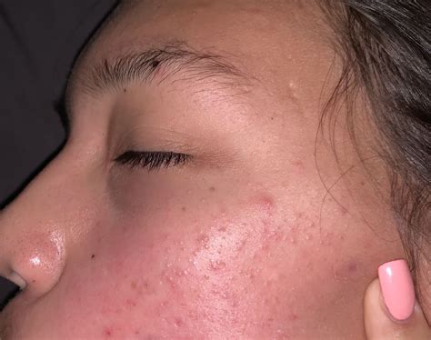 Small Light Textured Bumps Help Other Acne Treatments Forum