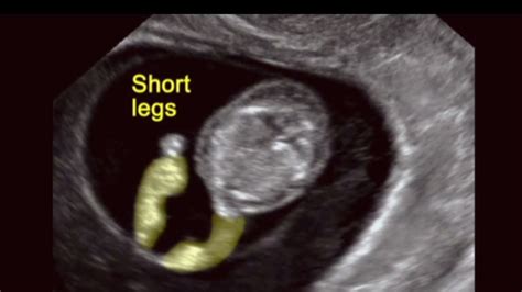 Ultrasound Of Fetal Skeletal Anomalies Youtube