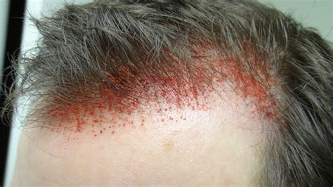 Your secret weapon against hair loss a derma stamp is a small handheld device featuring many small surgical needles. dermarolling.jpg