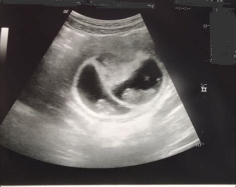 Weeks Pregnant Ultrasound Twins