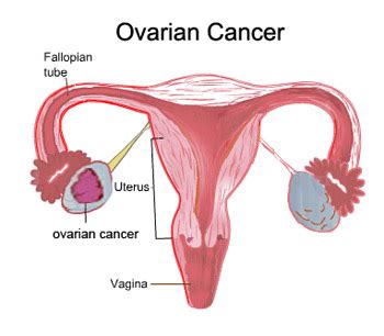 Irregular bleeding is most common among women with ovarian stromal tumors (though sheryl didn't have them), which only account for 1% of all ovarian cancers. Ovarian Cancer: Women Fitness