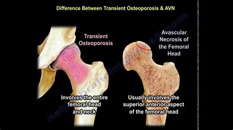 What Is Transient Osteoporosis Of The Hip Sitahw