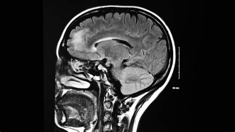 An Abnormal Mri Of The Brain Showing Sclerotic Lesions Usually