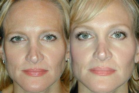 Before And After This 45 Year Old Woman Came In For Botox Cosmetic In My