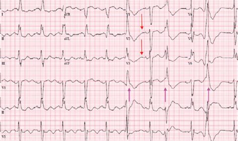 Shockingly Dangerous Hypokalemia Emra