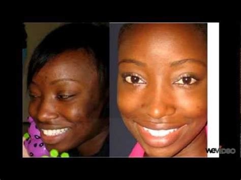 Then i found out about your pigmentation cream. Meladerm - YouTube