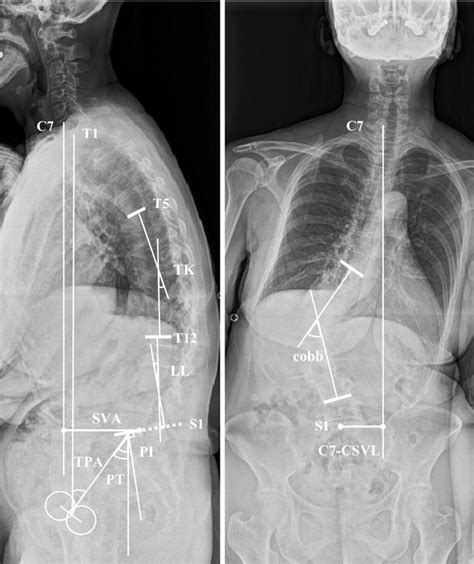 Representation Of Measured Static Spinal Parameters Sva The Sagittal Download Scientific