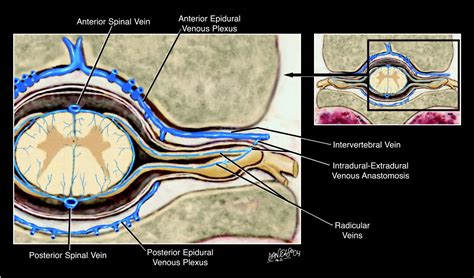 Intradural Spinal Vein Enlargement In Craniospinal Hypotension American Journal Of Neuroradiology
