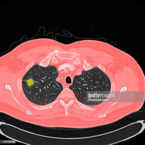 Chest Ct Scan Fotografías E Imágenes De Stock Getty Images