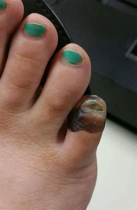 Spider Bite Woman Almost Loses Part Of Foot After Avoiding The Doctor