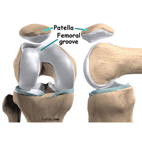 Patella Instability Brisbane Knee And Shoulder Clinic Dr