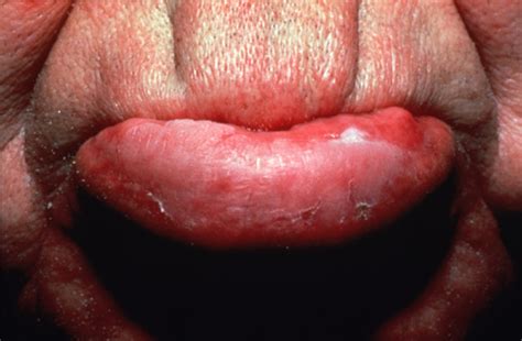 Leukoplakia is a white patch that develops in the mouth. Leukoplakia