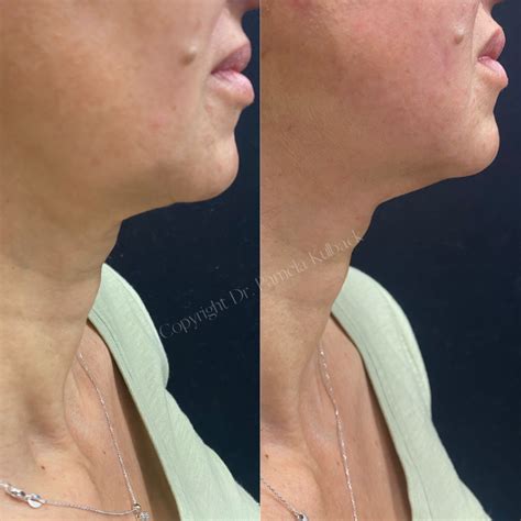Pdo Thread Lift For Face Neck And Body We Can Also Treat Acne Scars