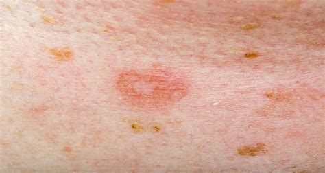 Erythema Multiforme Causes Symptoms And Possible Treatments