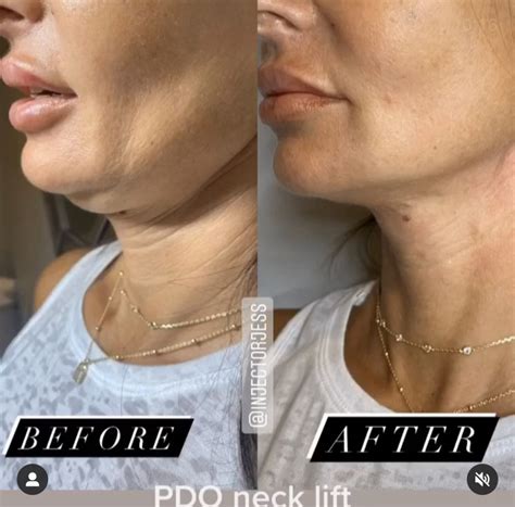 Pdo Neck Lift Lux Injectable