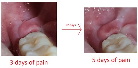 Black Micro Dots On Gum I Have Pericoronitis Do You Have Any Advice