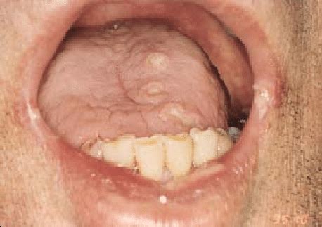 Herpes Simplex Virus On The Dorsum Of The Tongue And C Albicans On The Download Scientific